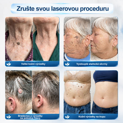 Oficiální značkový obchod | 🐬Hiskin® 7denní odstraňovač skvrn a pigmentových skvrn (Bezbolestný rollerball bez jizev)