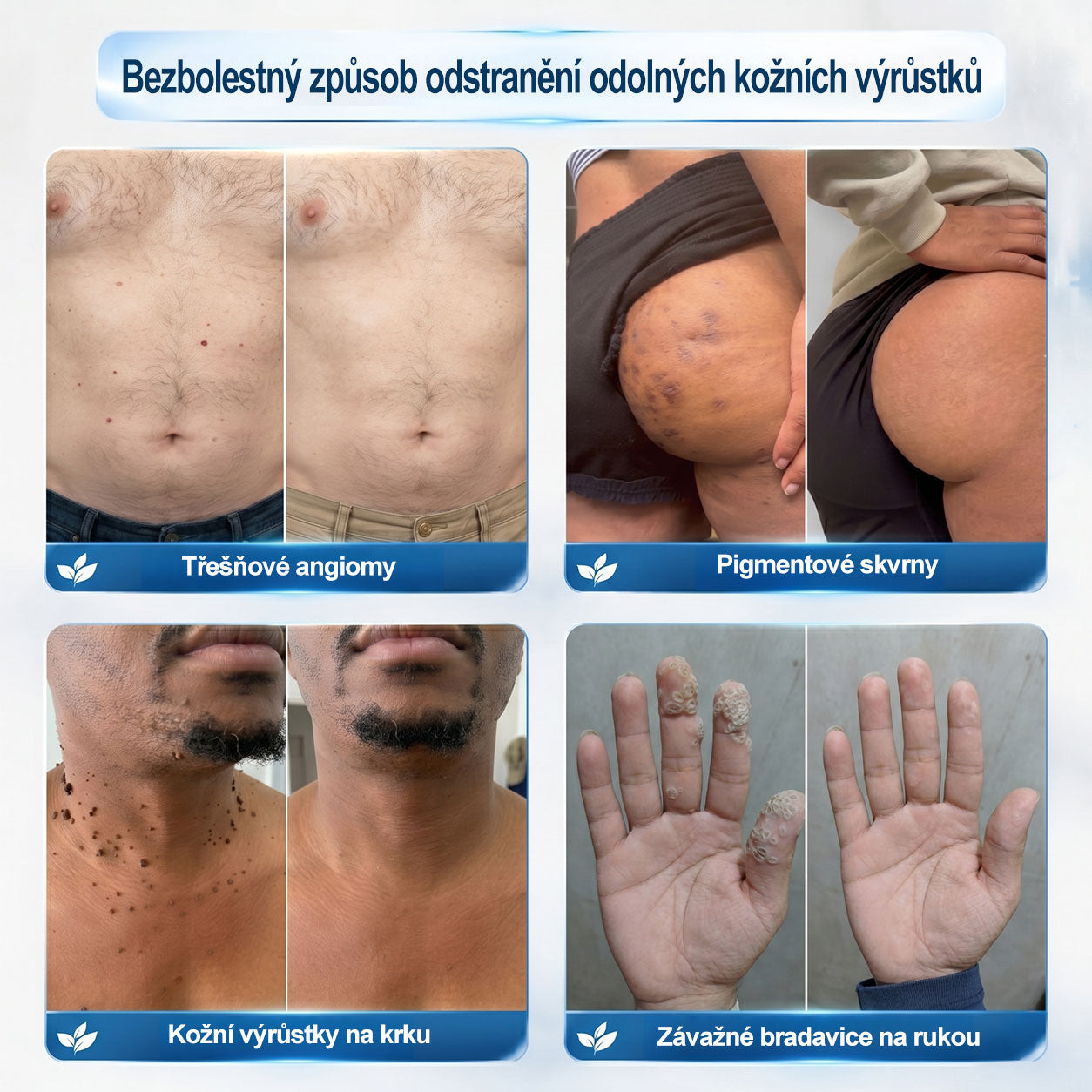 Oficiální značkový obchod | 🐬Hiskin® 7denní odstraňovač skvrn a pigmentových skvrn (Bezbolestný rollerball bez jizev)