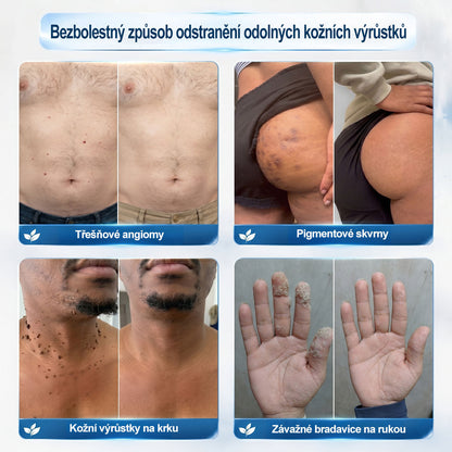 Oficiální značkový obchod | 🐬Hiskin® 7denní odstraňovač skvrn a pigmentových skvrn (Bezbolestný rollerball bez jizev)